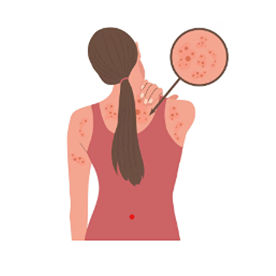 Pharmacy First-Shingles
