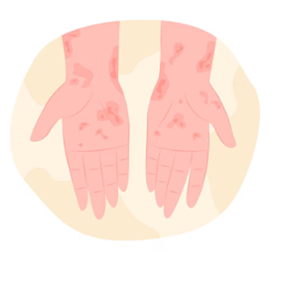 Pharmacy First-Skin Infection