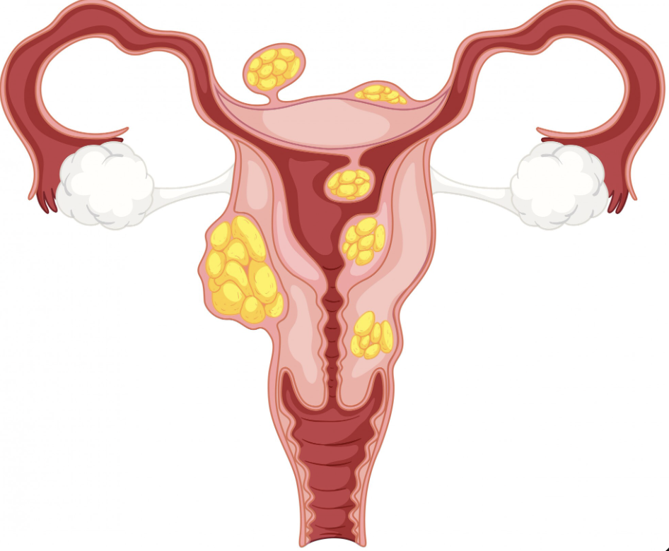 Genital Chlamydia Trachomatis