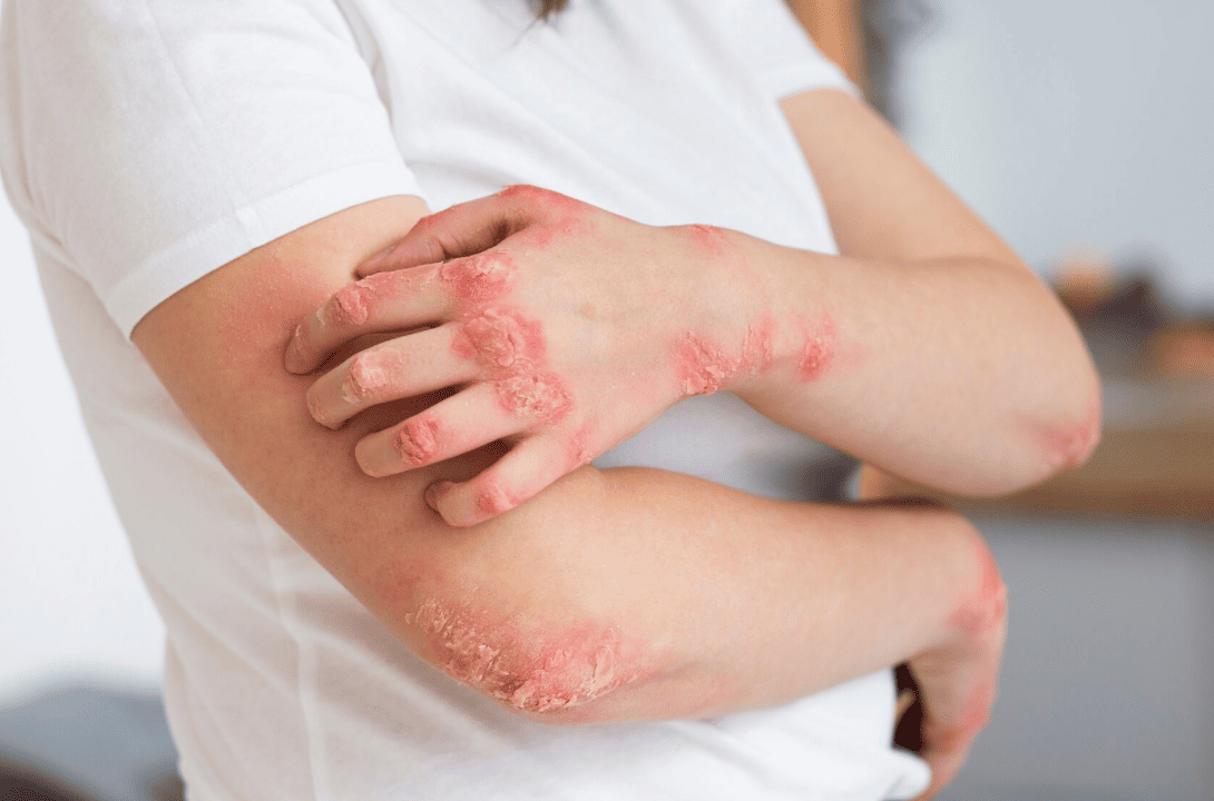ALEX2 Allergy Test