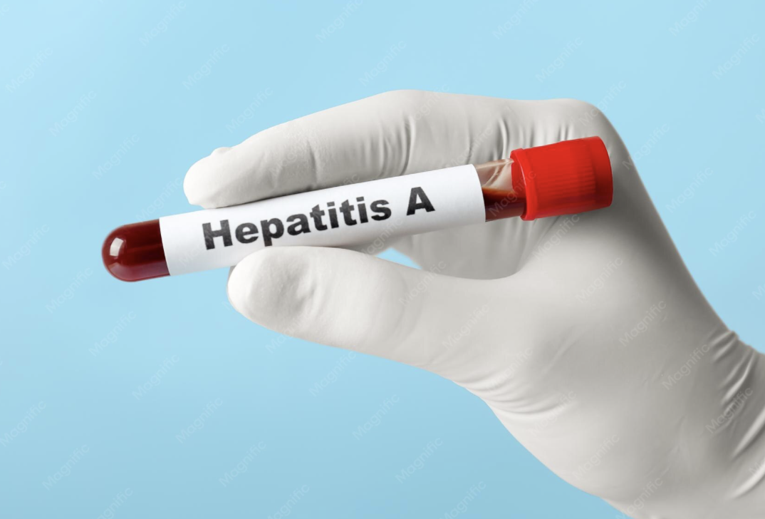 Hepatitis A