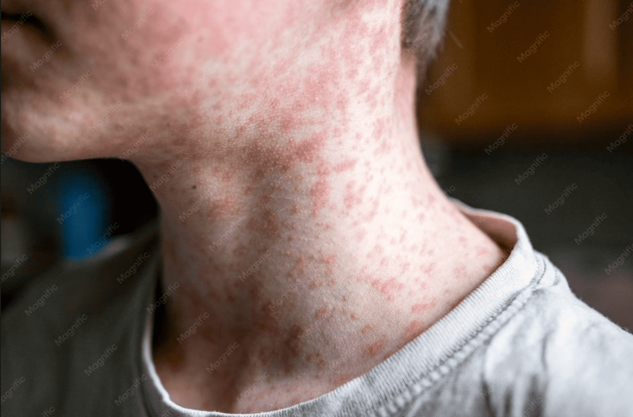 Impetigo