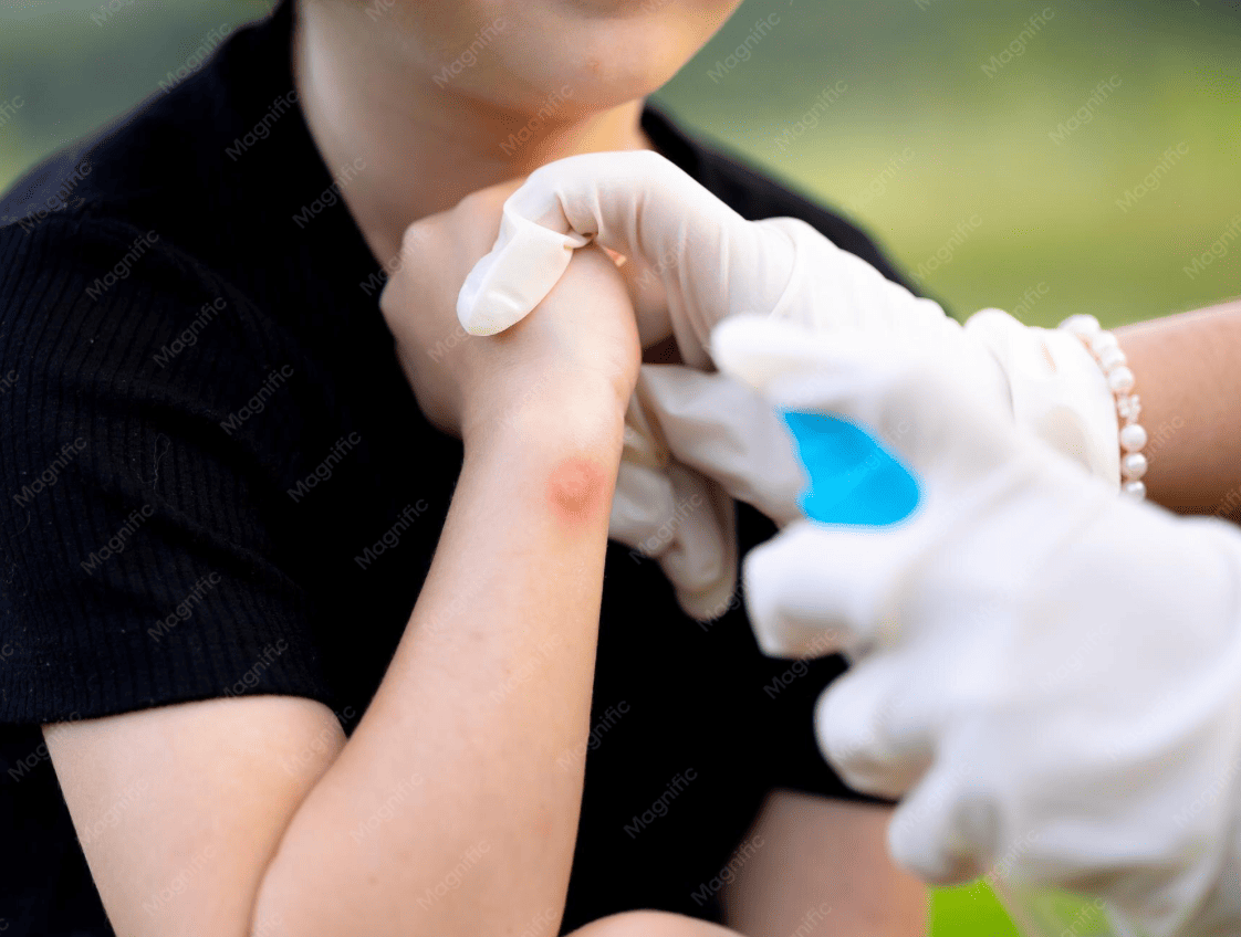Insect Bite