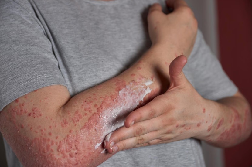 Pharmacy First - Impetigo