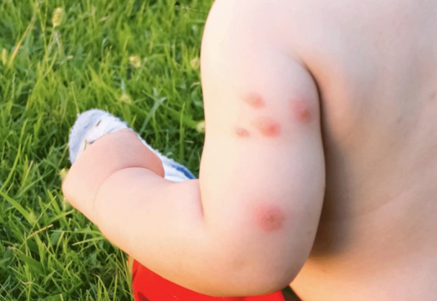 Pharmacy First - Insect Bite