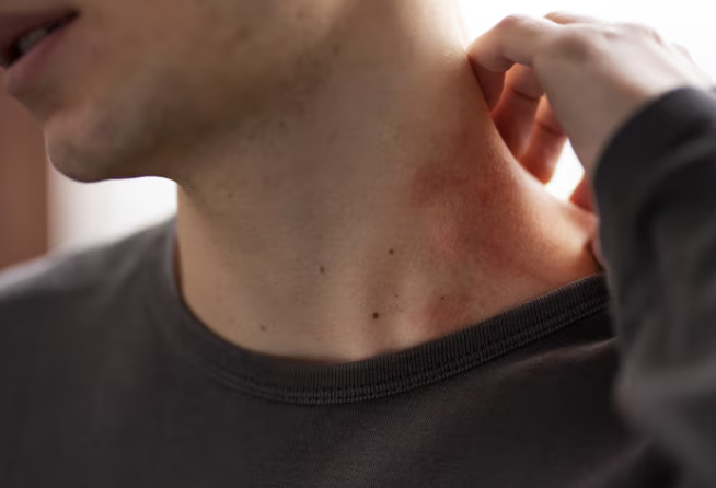 Shingles Vaccine