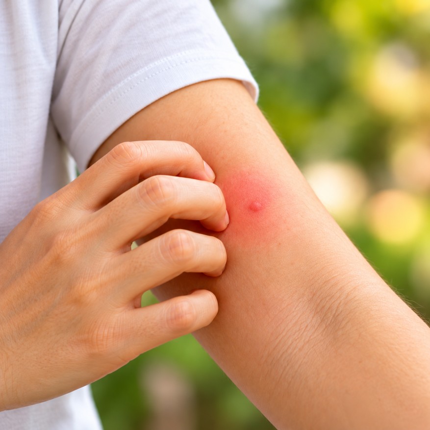 Pharmacy First - Insect Bite