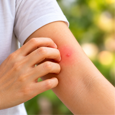 Pharmacy First - Insect Bite